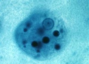 راه های پیشگیری از عفونت روده ای چیست؟