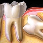 درمان دندان نهفته را به تعویق نیندازید
