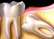درمان دندان نهفته را به تعویق نیندازید