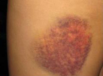 خون‌مردگی‌های زیر پوست، چرا و چگونه؟