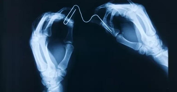 چرا اشیاء فلزی قبل از رادیولوژی باید خارج شوند؟ بررسی تاثیر فلزات بر عکس X-ray