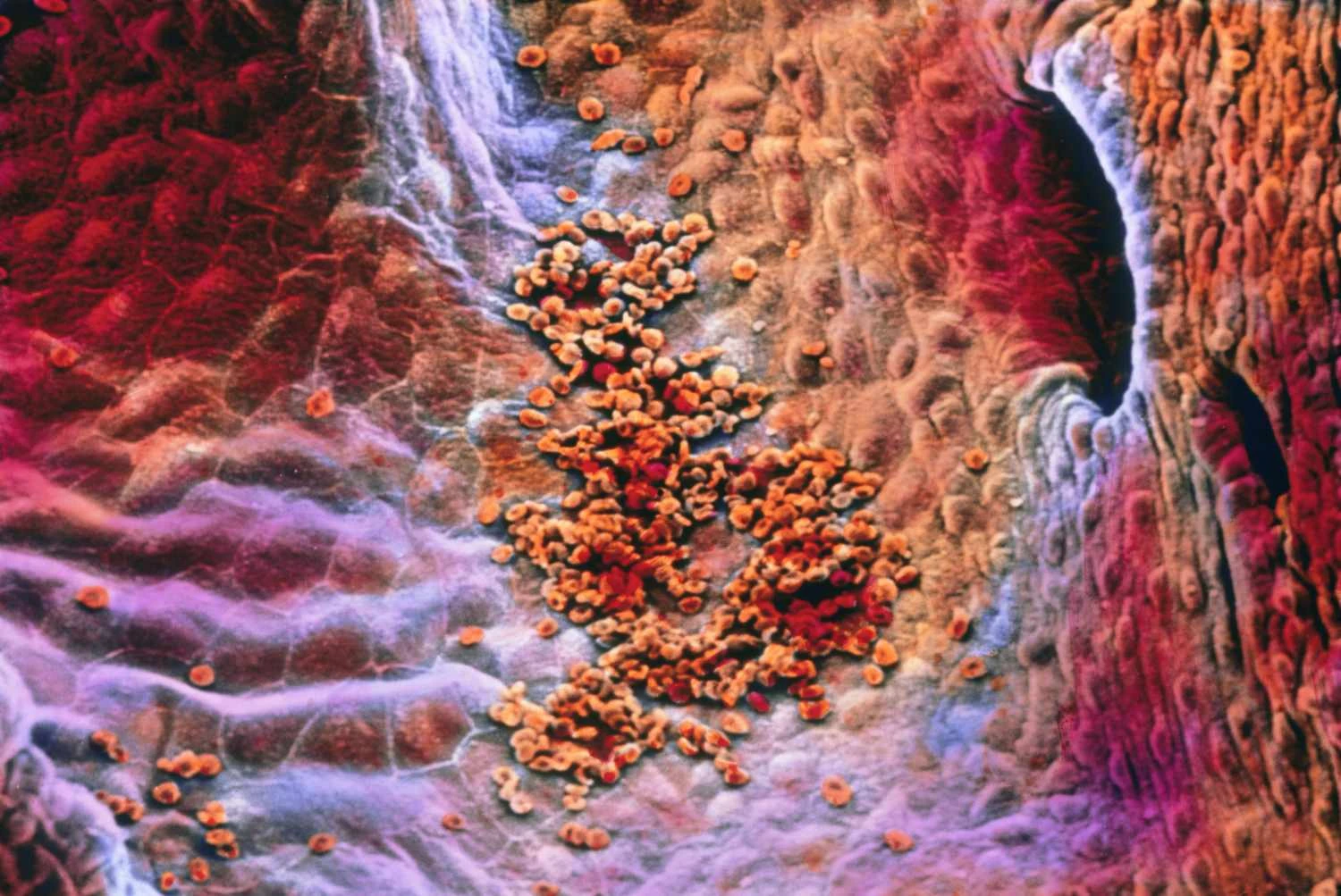 اندوکاردیوم