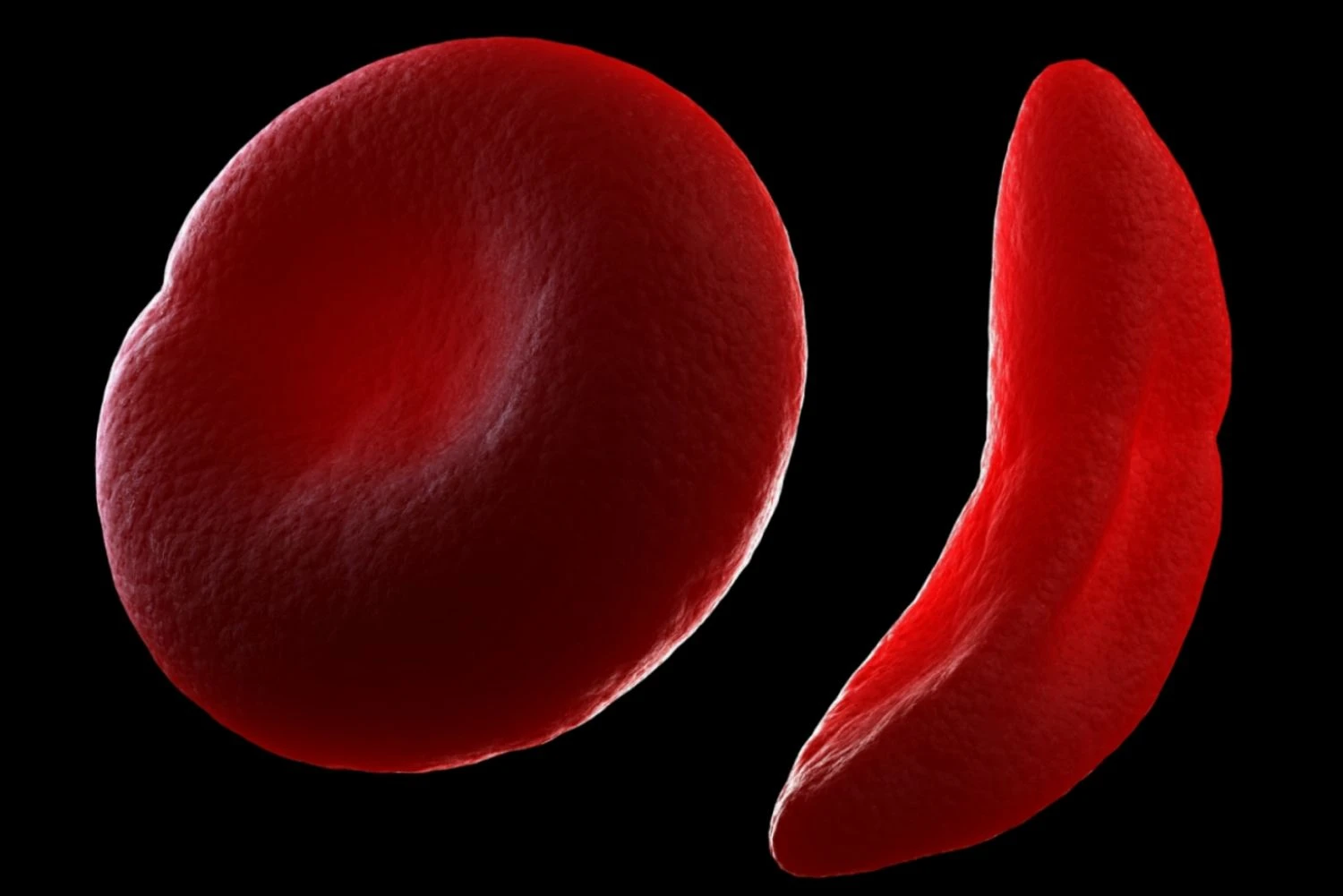 این تصویر یک گلبول قرمز سالم (در سمت چپ) و یک گلبول داسی شکل (در سمت راست) را نشان می دهد.